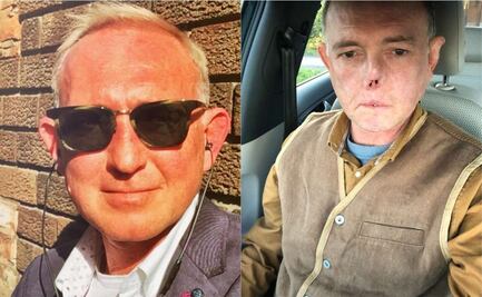 Este doctor perdió las piernas y su nariz, por una lamida de su perro