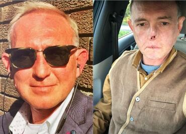 Este doctor perdió las piernas y su nariz, por una lamida de su perro