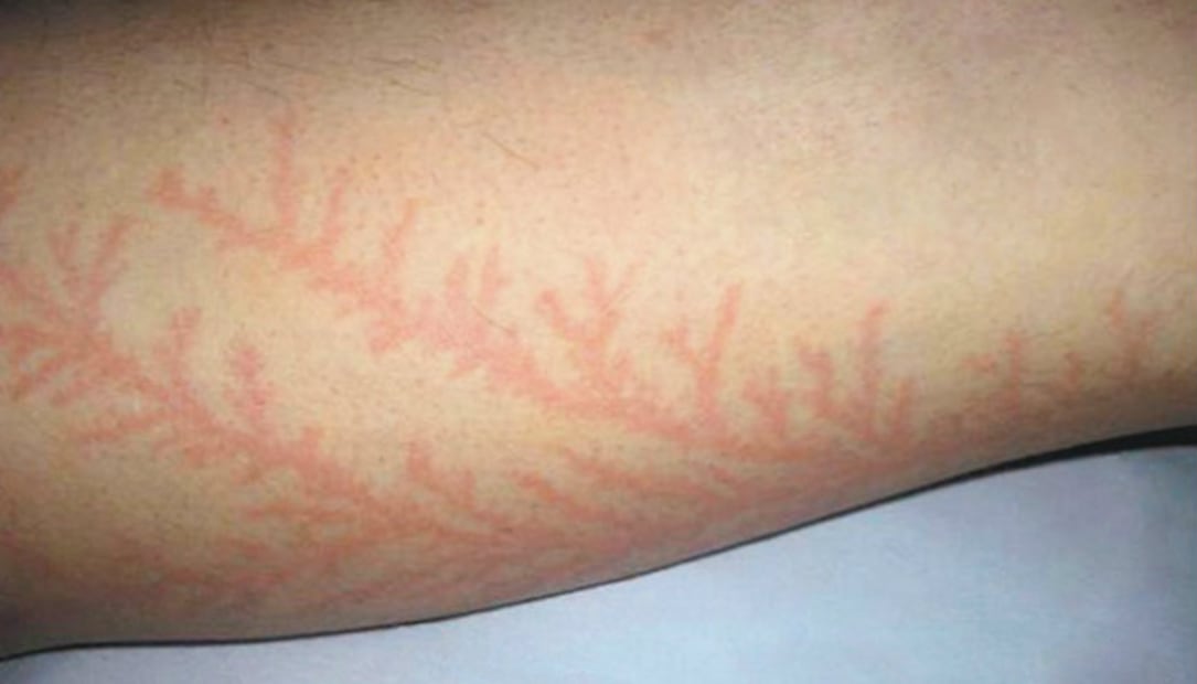 Figuras de Lichtenberg, los “tatuajes” naturales creados por los rayos