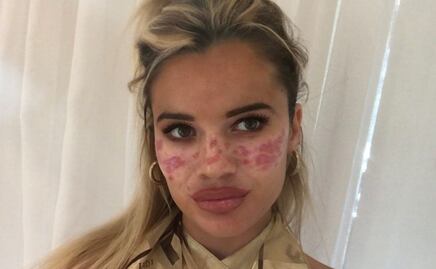 Joven se quema el rostro por hacer un video viral en TikTok