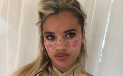 Joven se quema el rostro por hacer un video viral en TikTok