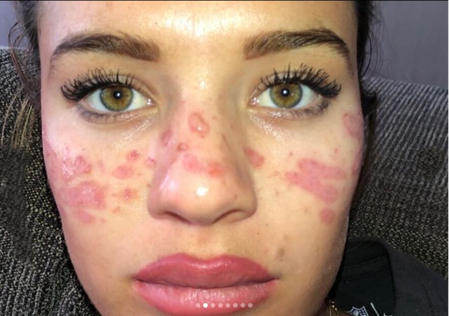 Joven se quema el rostro por hacer un video viral en TikTok
