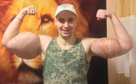 “Hulk ruso” opera sus músculos para salvar sus brazos y su vida