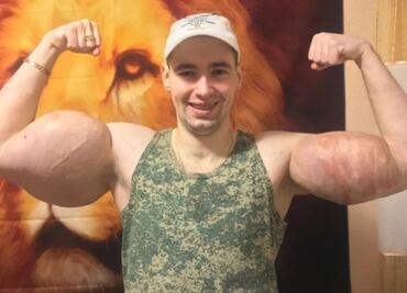 “Hulk ruso” opera sus músculos para salvar sus brazos y su vida