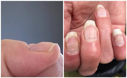 Uñas Covid: El nuevo síntoma tras la enfermedad