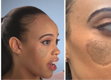 Le injertaron piel de la ingle en su cara y le salió vello púbico