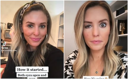 Influencer se inyecta botox en la cara y se le cae el párpado