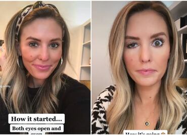 Influencer se inyecta botox en la cara y se le cae el párpado