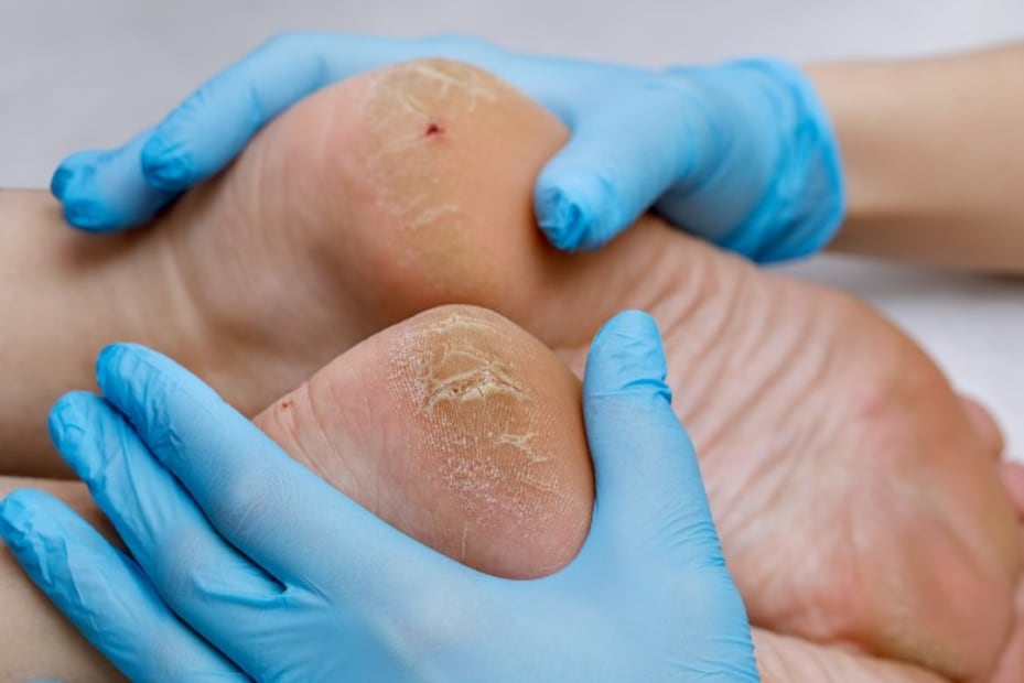 ¿Tienes diabetes? 5 tips para prevenir el pie diabético