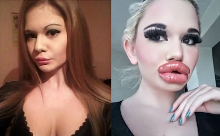 Ella es la mujer que quiere tener los labios más grandes del mundo
