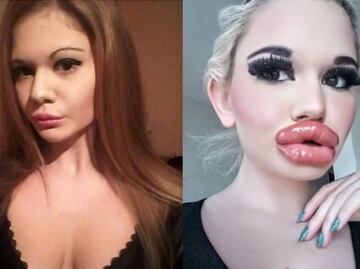 Ella es la mujer que quiere tener los labios más grandes del mundo