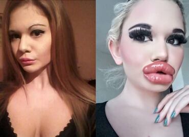 Ella es la mujer que quiere tener los labios más grandes del mundo