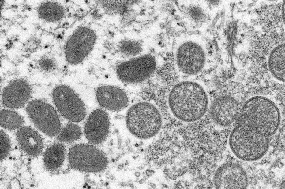 Viruela del mono: ¿Cuáles son los síntomas y cómo evitar contagio?