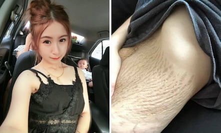 Tuvo cuatrillizos y tuvo el valor de mostrar sus estrías