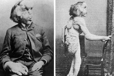 El “hombre elefante”, la deformidad de un rostro triste