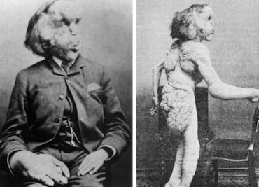 El “hombre elefante”, la deformidad de un rostro triste