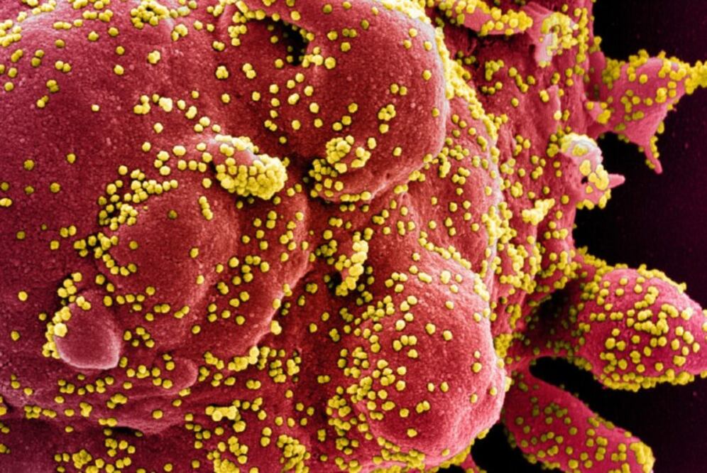 Célula (en rojo) en proceso de apoptosis o muerte celular, infectada por el coronavirus SARS-CoV2 (puntos amarillos) (Foto: NIAID)