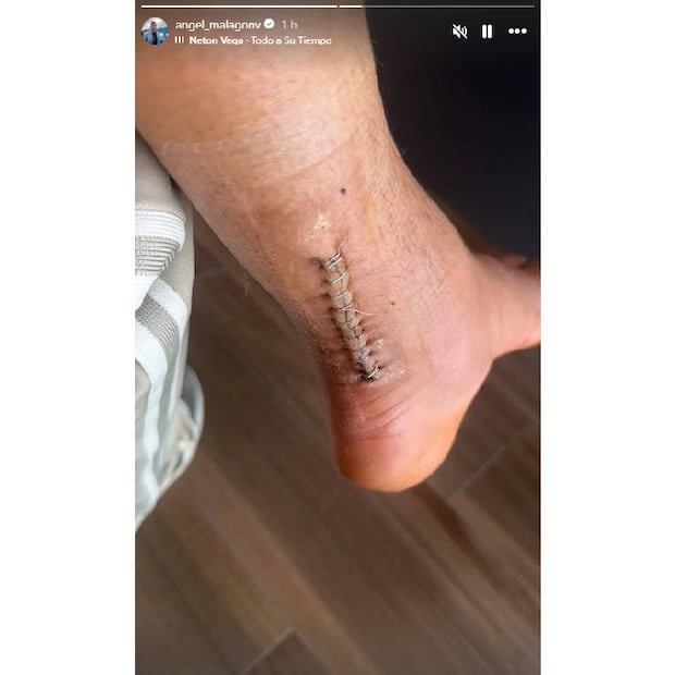 Así luce la cicatriz que quedó en el tobillo de Luis Ángel Malagón tras su operación. FOTO: @angel_malagonv