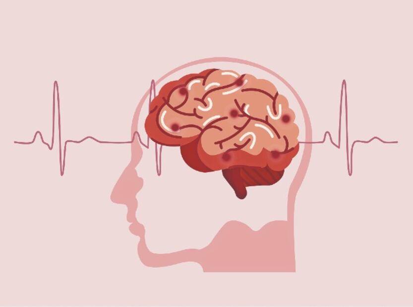 Día Mundial del Parkinson y la estimulación cerebral profunda como tratamiento