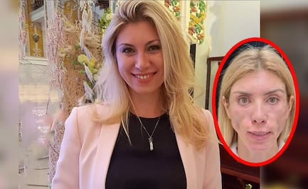 A modelo rusa le desfiguran el rostro en cirugía estética y quedó así…