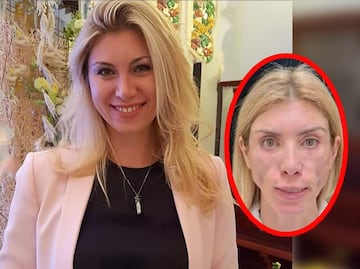 A modelo rusa le desfiguran el rostro en cirugía estética y quedó así…