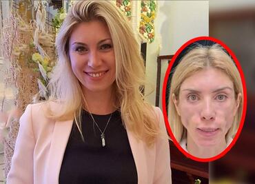 A modelo rusa le desfiguran el rostro en cirugía estética y quedó así…