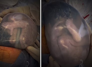 Sorprendente video de bebé dentro de su bolsa amniótica se hace viral