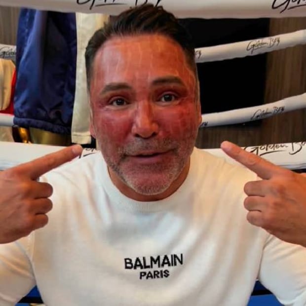 El rostro del Golden Boy queda totalmente rojo después de su tratamiento estético. Foto: Especial