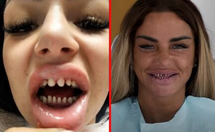 “Dientes de tiburón”: La peligrosa tendencia de afilarse los dientes