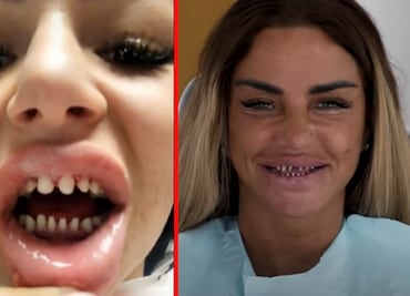 “Dientes de tiburón”: La peligrosa tendencia de afilarse los dientes