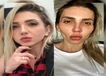 A influencer brasileña se le "cae la cara” tras una cirugía estética