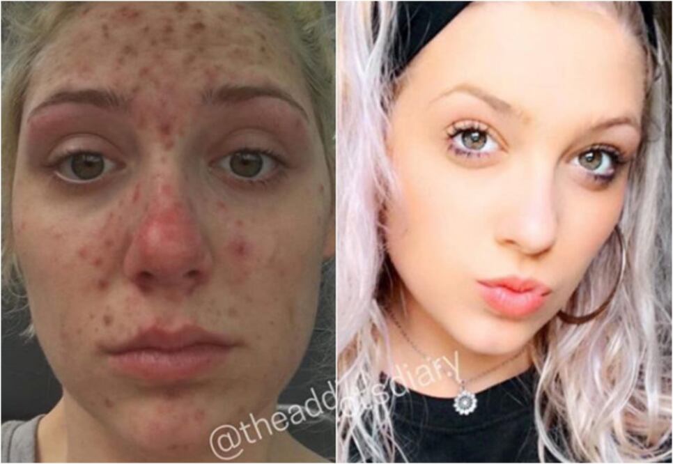 “No podía imaginar una vida sin drogas”, comenta esta chica. “Este es solo el principio, no puedo esperar a ver lo que la sobriedad me ofrece, porque sé que va a ser tan hermoso”, señala. (Foto: The Addict’s Diary)