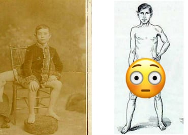El hombre que nació con tres piernas y dos penes