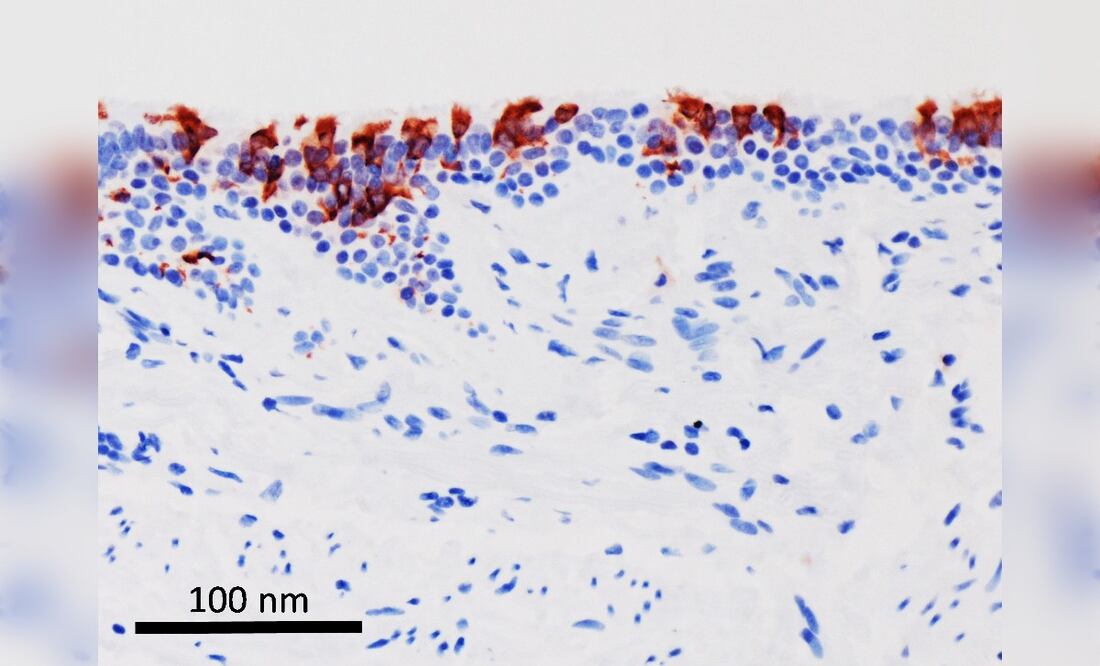 La variante omicrón del SARS-CoV-2 (en rojo) infectando tejidos de bronquios humanos. (Foto: Universidad de Hong Kong vía EuropaPress)