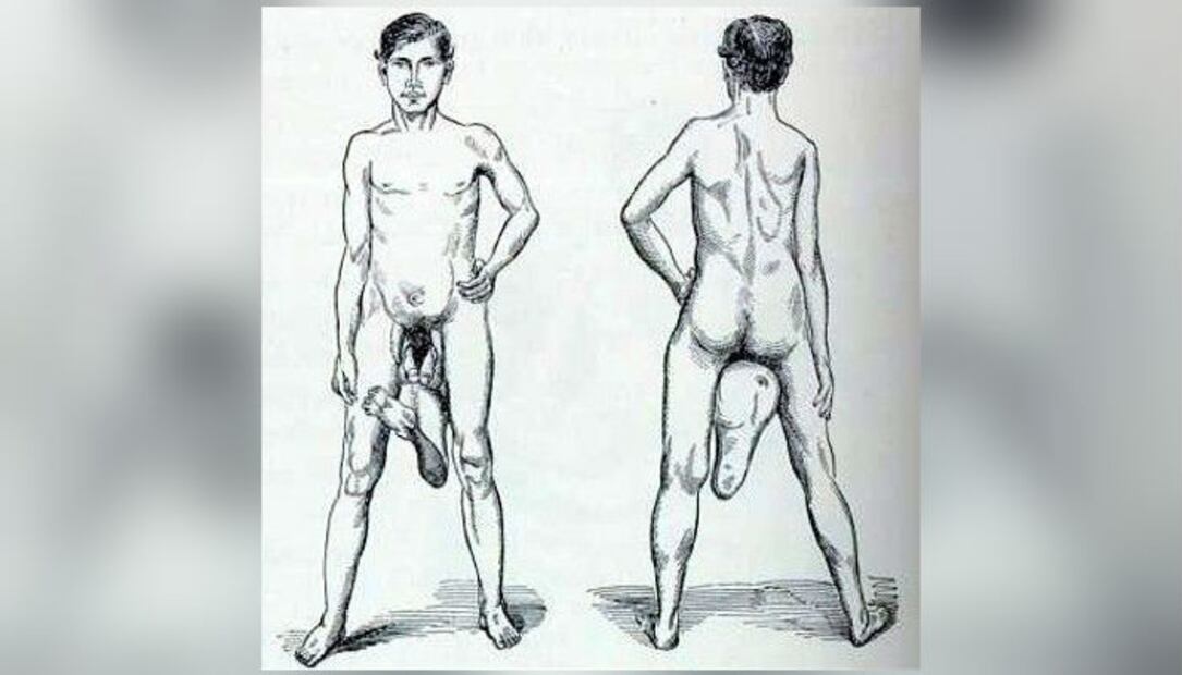 El hombre que nació con tres piernas y dos penes