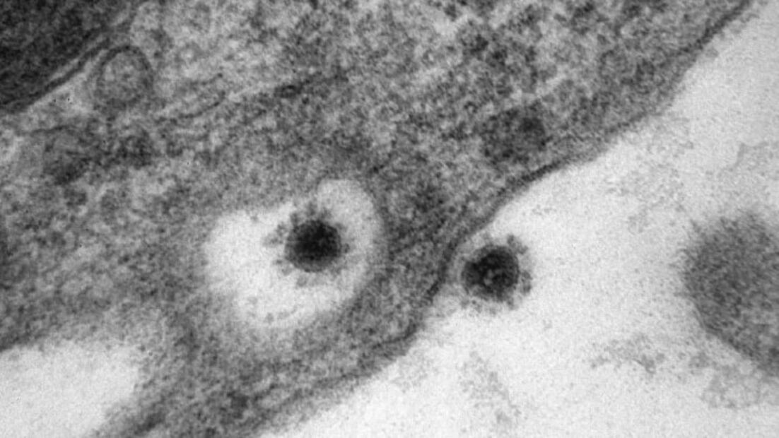Así se ve la cepa de la variante Delta de Covid en un microscopio