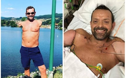 La historia del hombre que recibió el primer trasplante doble de brazos