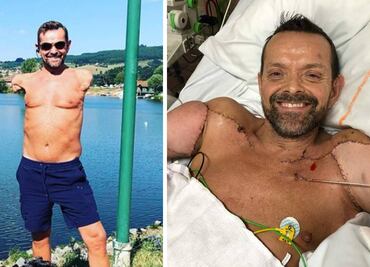 La historia del hombre que recibió el primer trasplante doble de brazos