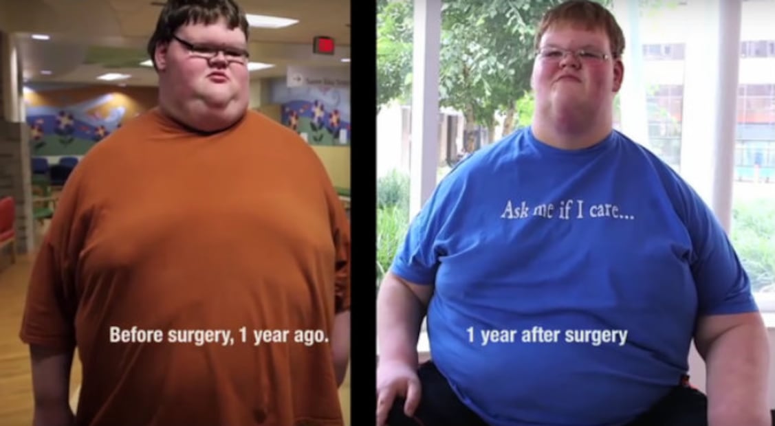 10 casos extremos de personas con obesidad que lograron bajar de peso