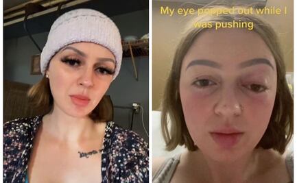 A mujer embarazada se le “sale” el ojo durante el parto