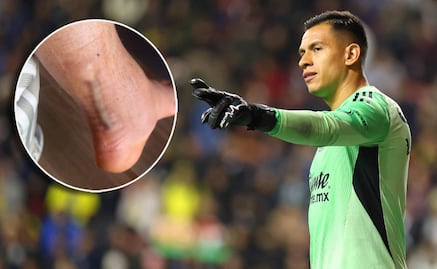 Luis Ángel Malagón compartió impresionante imagen de la cicatriz que le dejó su operación de talón