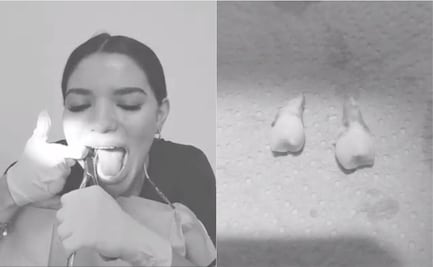 Video de dentista que se extrae sola las “muelas del juicio” se hace viral