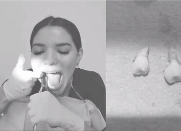 Video de dentista que se extrae sola las “muelas del juicio” se hace viral