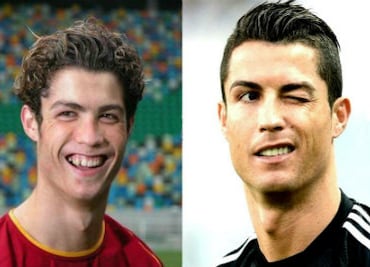 Futbolistas que se sometieron al bisturí por vanidad