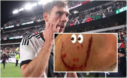 La Selección Mexicana sí es agresiva, Goretzka mostró las huellas de la batalla ante el Tri