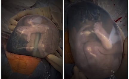 Video de bebé dentro de su bolsa amniótica se hace viral