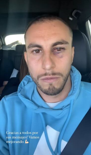 Alejandro Mayorga y su ojo lastimado