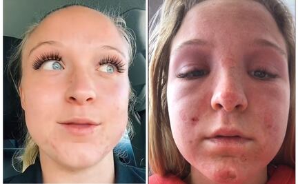 Le queman el rostro a joven en cama de bronceado y lo cuenta en TikTok