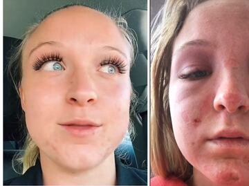 Le queman el rostro a joven en cama de bronceado y lo cuenta en TikTok