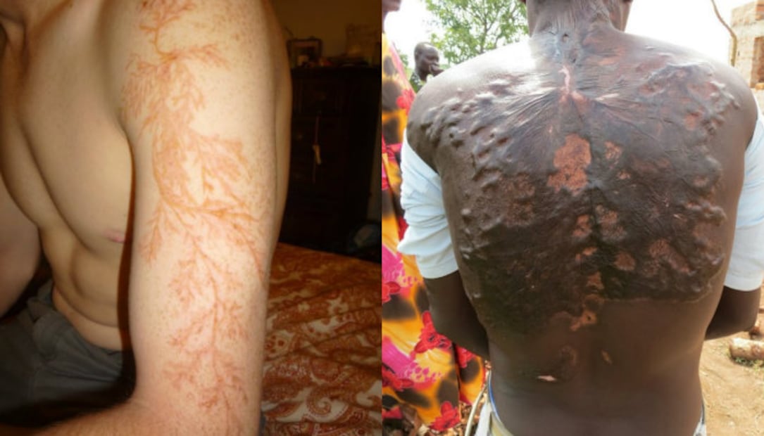 Figuras de Lichtenberg, los “tatuajes” naturales creados por los rayos